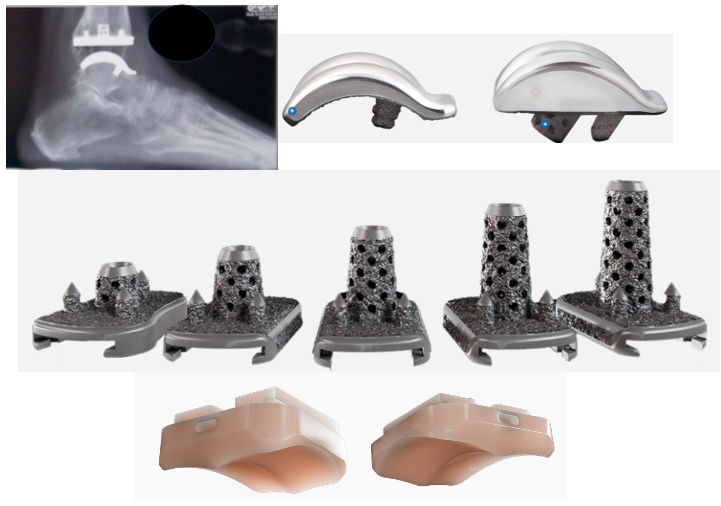 Vantage® Total Ankle System (Prod 250507)